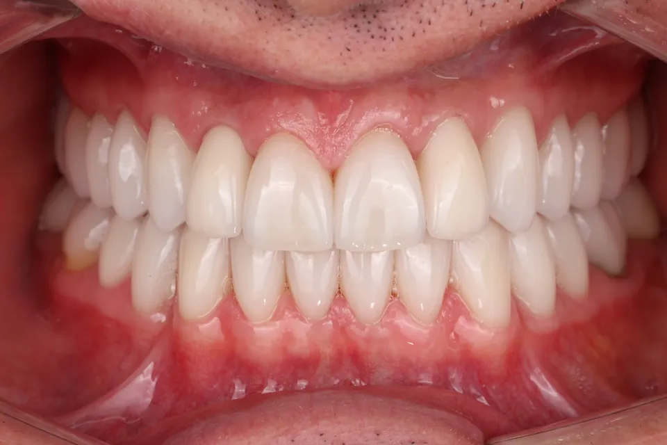 Dental arches after treatment: front view.