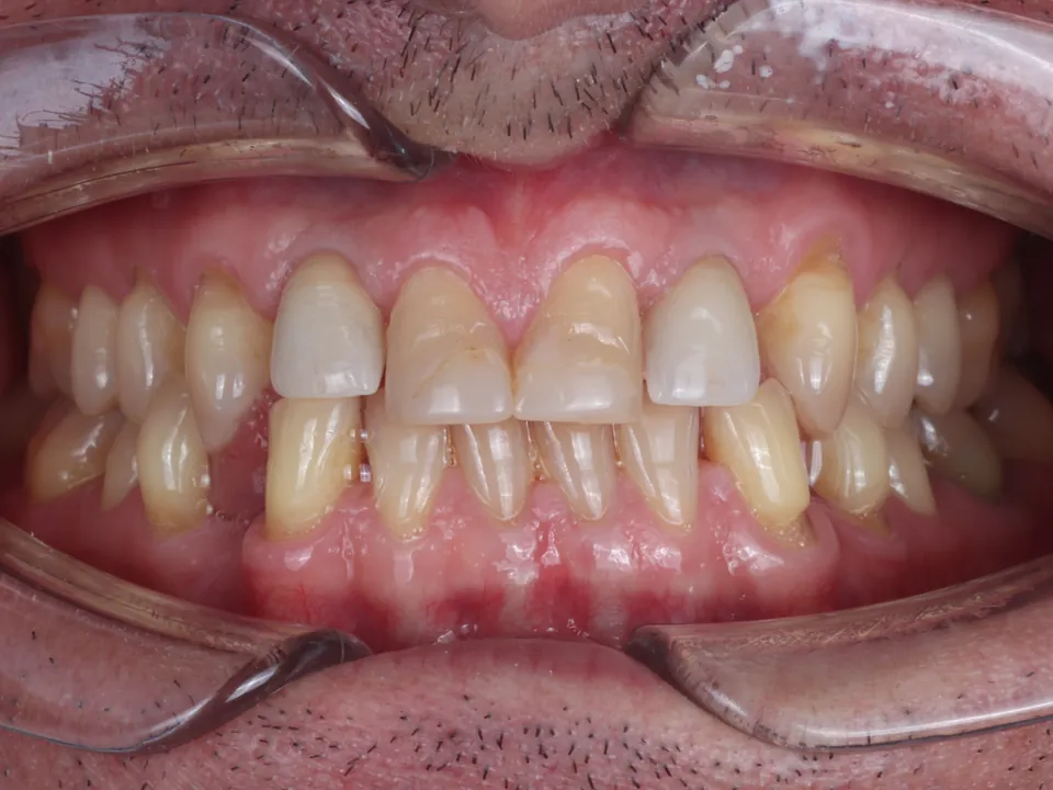 Dental arches before treatment: front view.