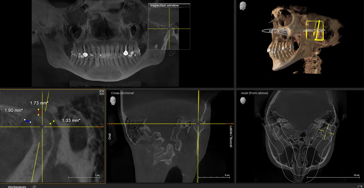 Temporomandibular joint CBCT: sectional views, a 3D reconstruction and joint-space measurements